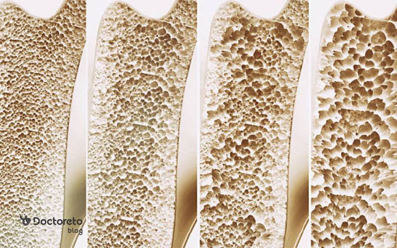 چه چیزی باعث پوکی استخوان میشود؟