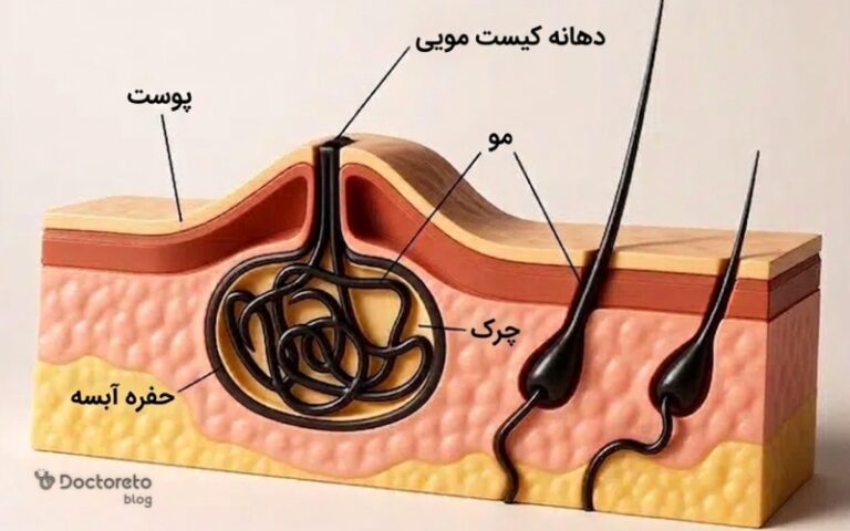 کیست مویی چیست؟