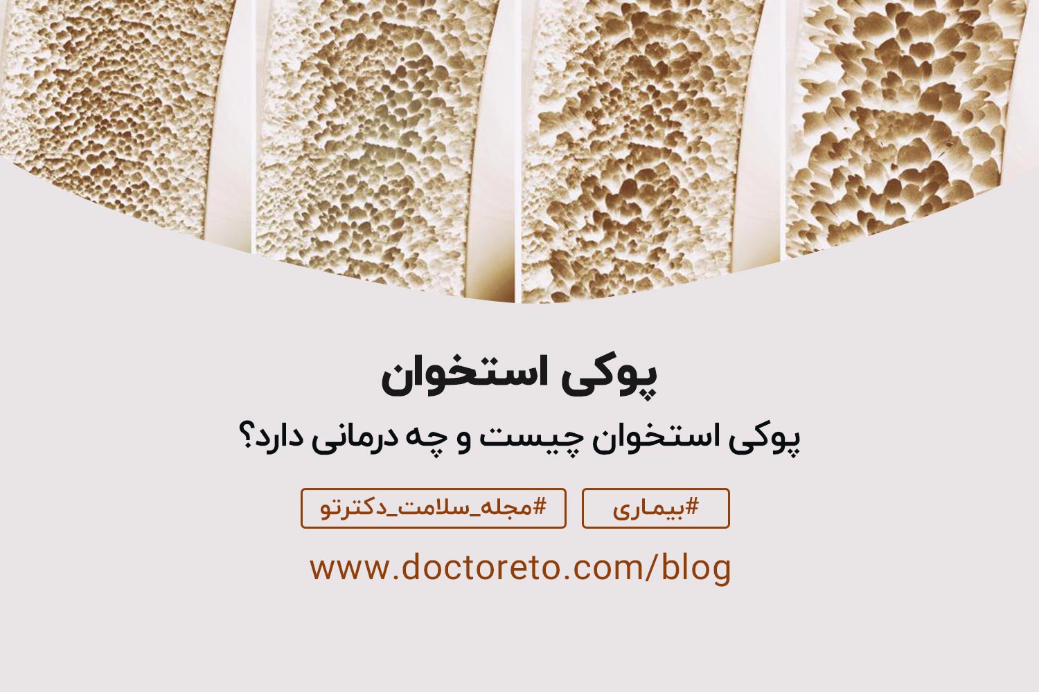 پوکی-استخوان دلایل پوکی استخوان چیست؟