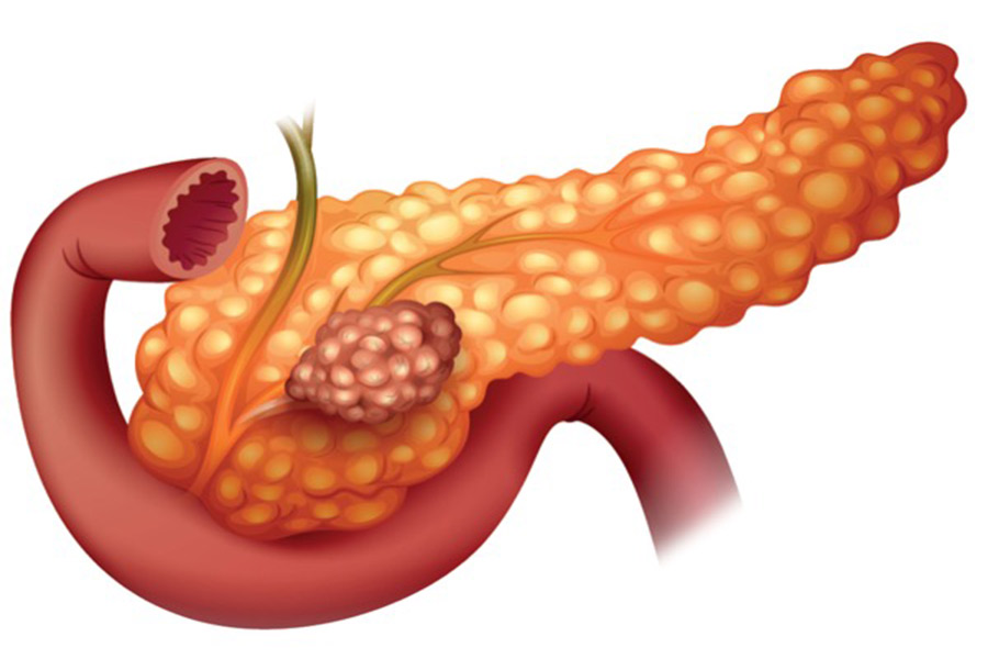 سرطان پانکراس یا سرطان لوزالمعده