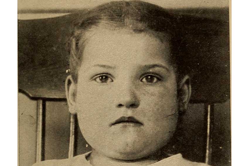 تصویر دختری مبتلا به بیماری اوریون در سال 1913. در آن زمان هنوز مسری بودن اوریون اثبات نشده بود.