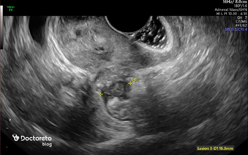 تشخیص اندومتریوز در سونوگرافی