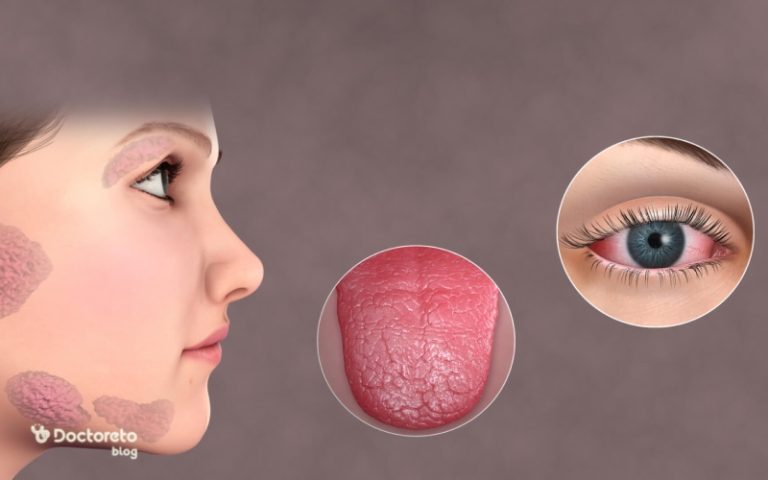 سندروم شوگرن چیست و چگونه تشخیص داده می‌ شود؟