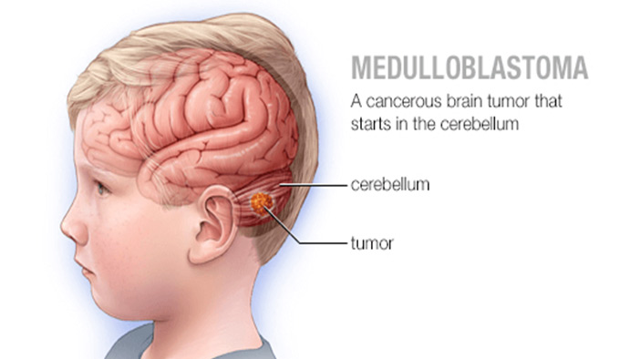 تومور-مغزی-در-کودکان