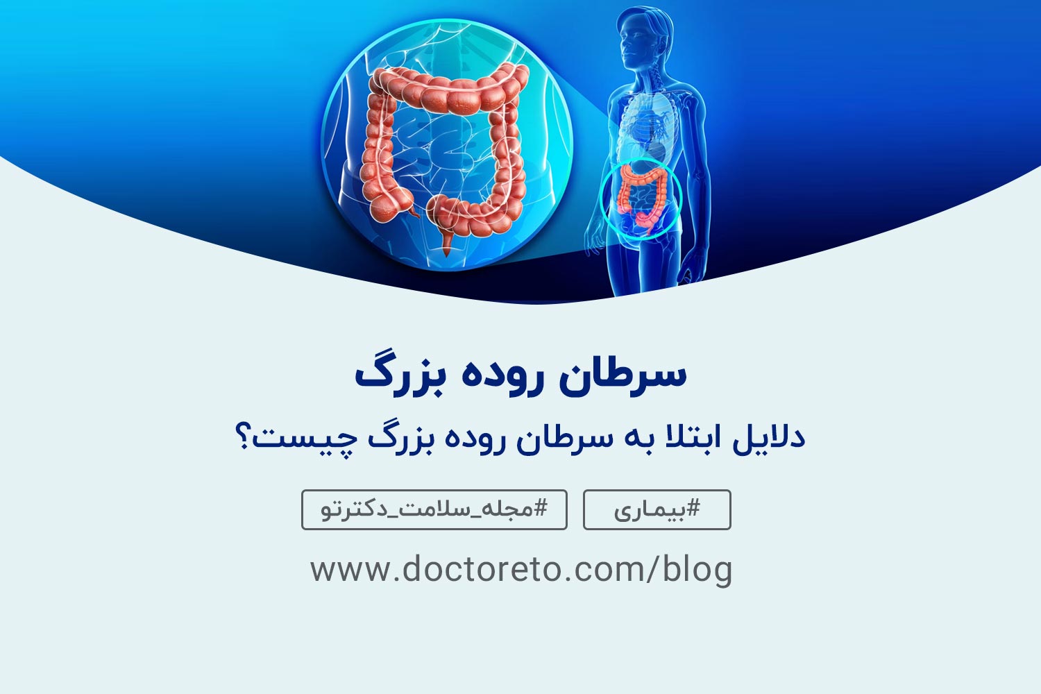 سرطان-روده-بزرگ سرطان روده بزرگ