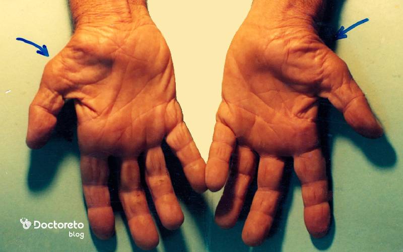 فیزیوتراپی تنگی کانال مچ دست برای درمان سندروم تونل کارپال