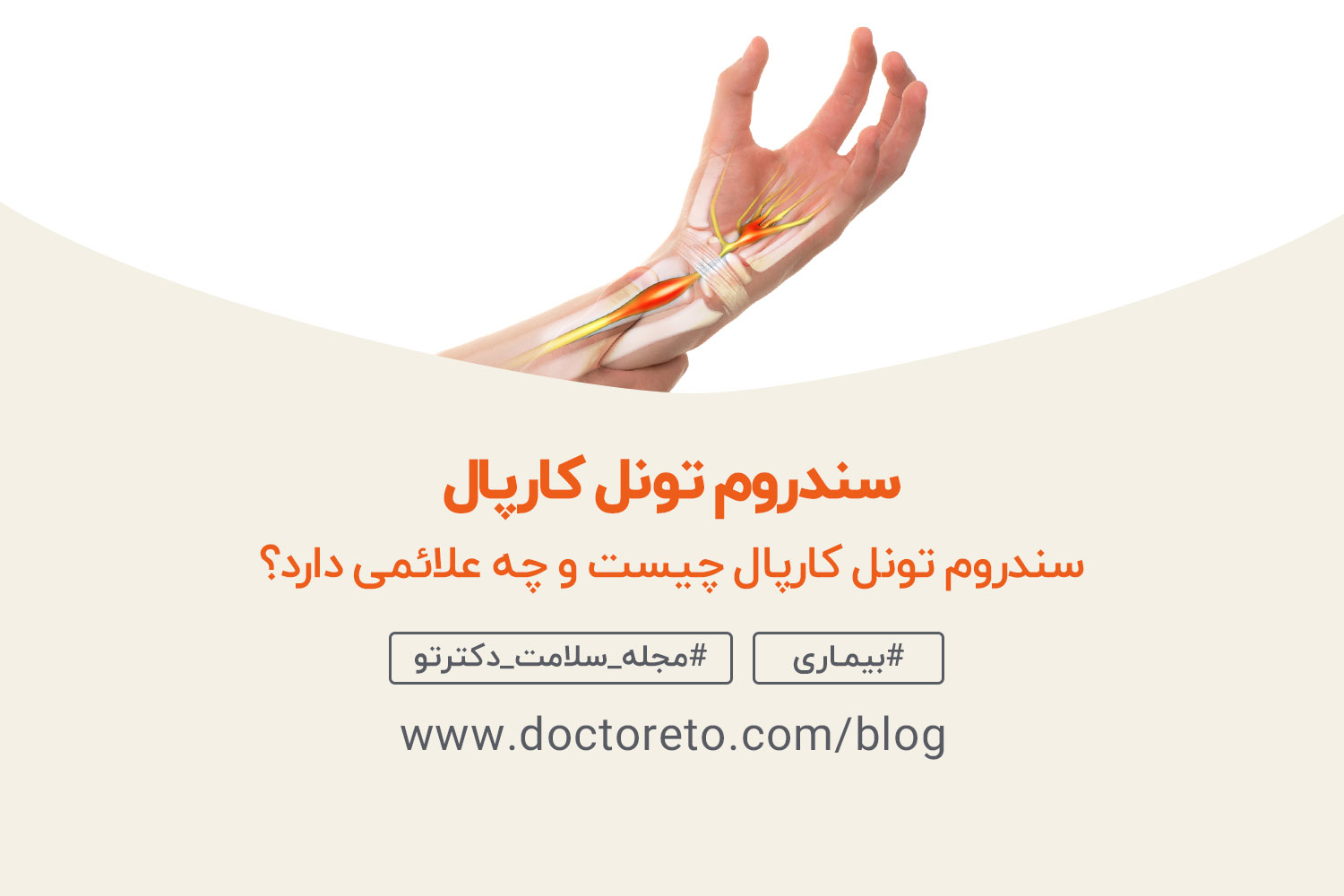 سندروم-تونل-کارپال یک دست که تونل کارپال در آن مشهود است