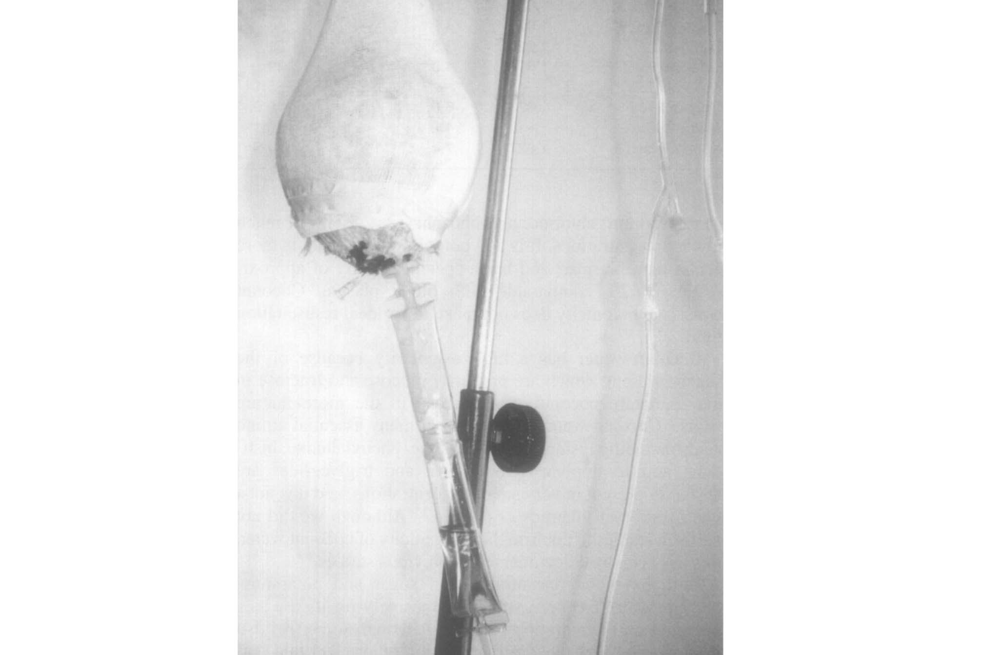 تزریق آب نارگیل به جای سرم به یک فرد در سال 1992