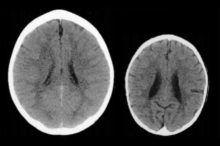 تصویر سمت راست ساختار مغز کودکی را نشان می‌دهد که از صفحات نمایش استفاده‌ای نداشته است. تصویر سمت چپ ساختار مغز کودکی با استفاده فراوان از صفحات نمایش است.