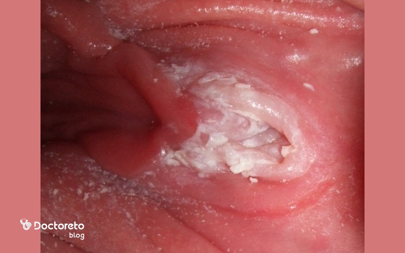 عکس واقعی عفونت قارچی واژن