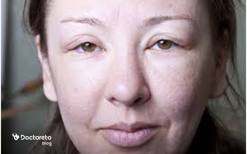 دلایل تورم صورت؛ ورم صورت نشانه چیست؟