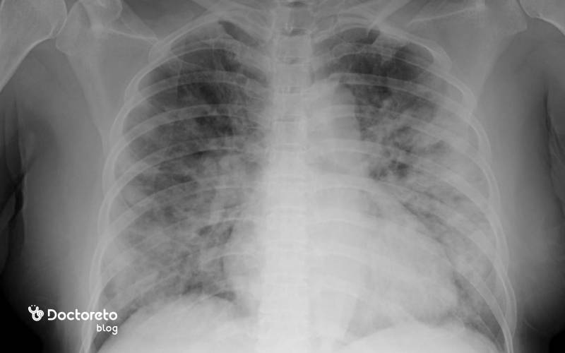 عکس ریه پنومونی