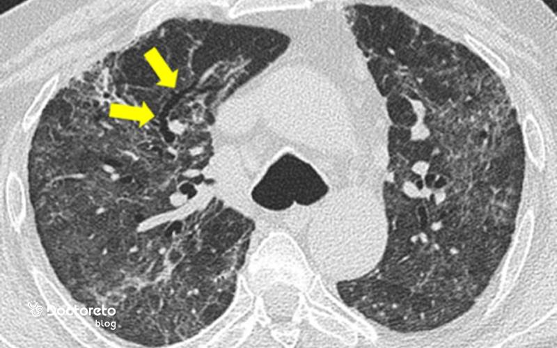 عوارض پنومونی ریه چیست؟