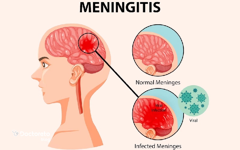 چه چیزی باعث مننژیت می شود و علت مننژیت چیست؟