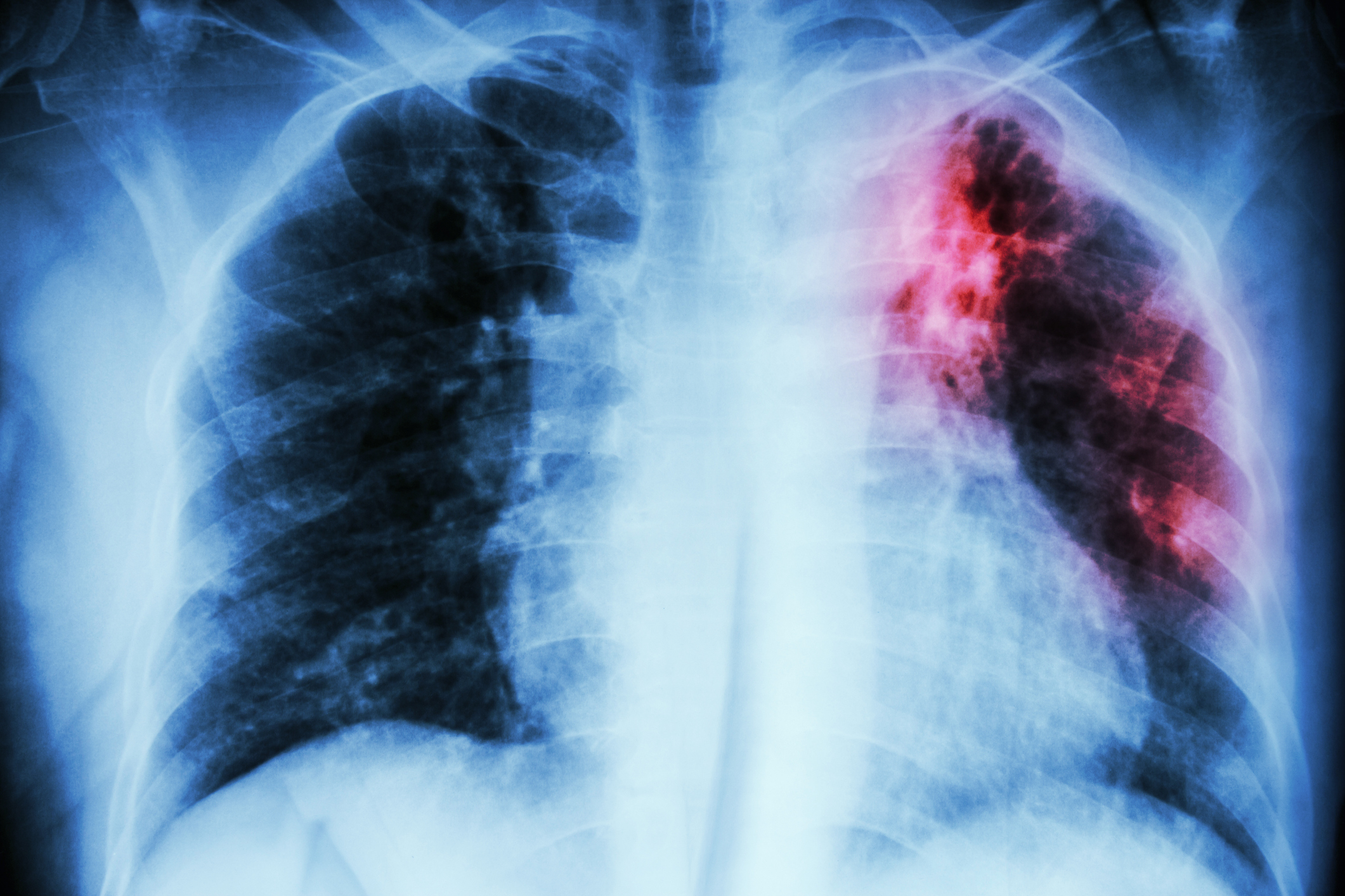 Tuberculosis سل