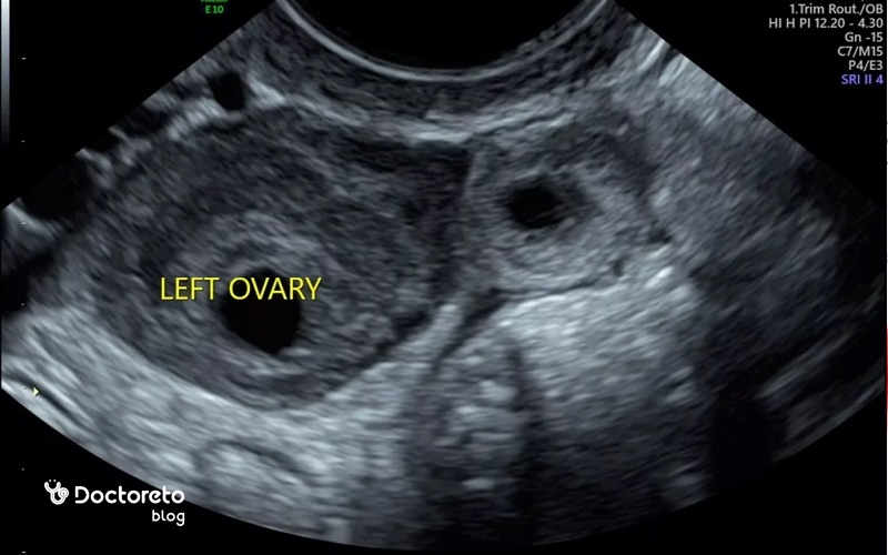 سونوگرافی حاملگی خارج رحم را نشان می دهد. 
