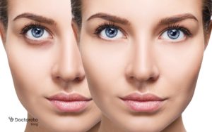 برای رفع گودی زیر چشم چه کنیم؟ انواع درمان خانگی و روش های پزشکی