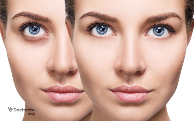 برای رفع گودی زیر چشم چه کنیم؟ انواع درمان خانگی و روش های پزشکی