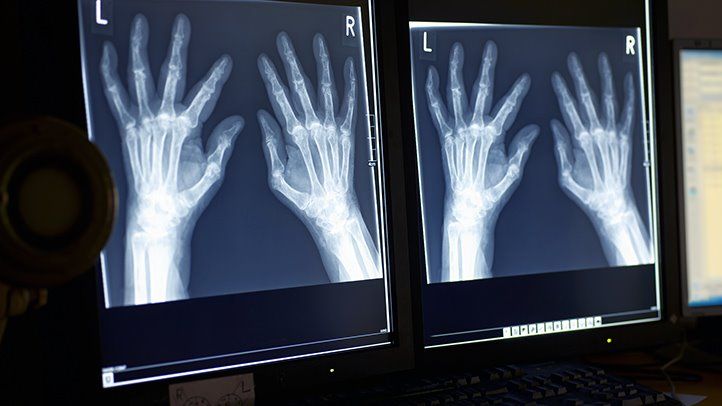 rheumatoid-arthritis-diagnosis