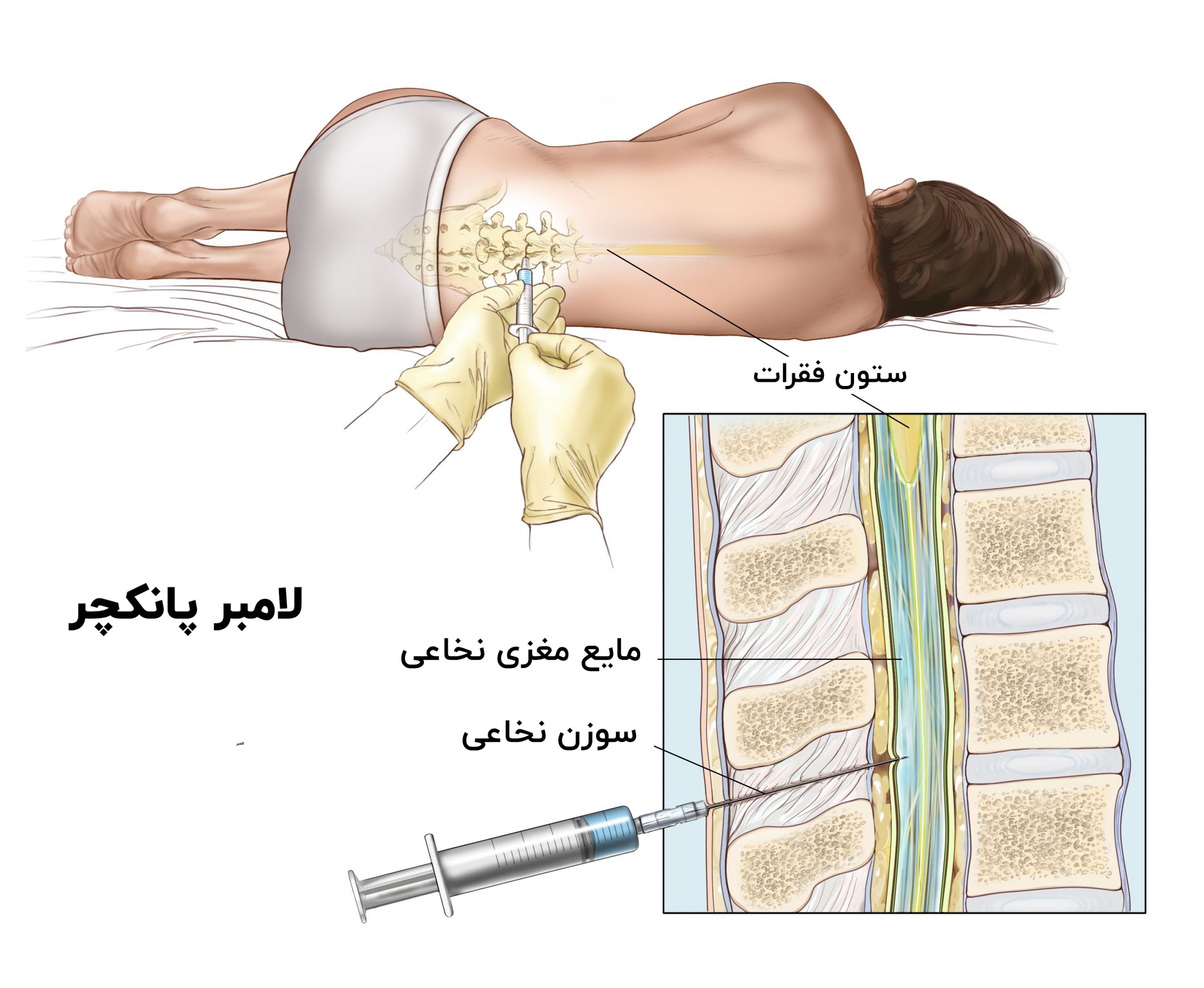 لامبر پانکچر