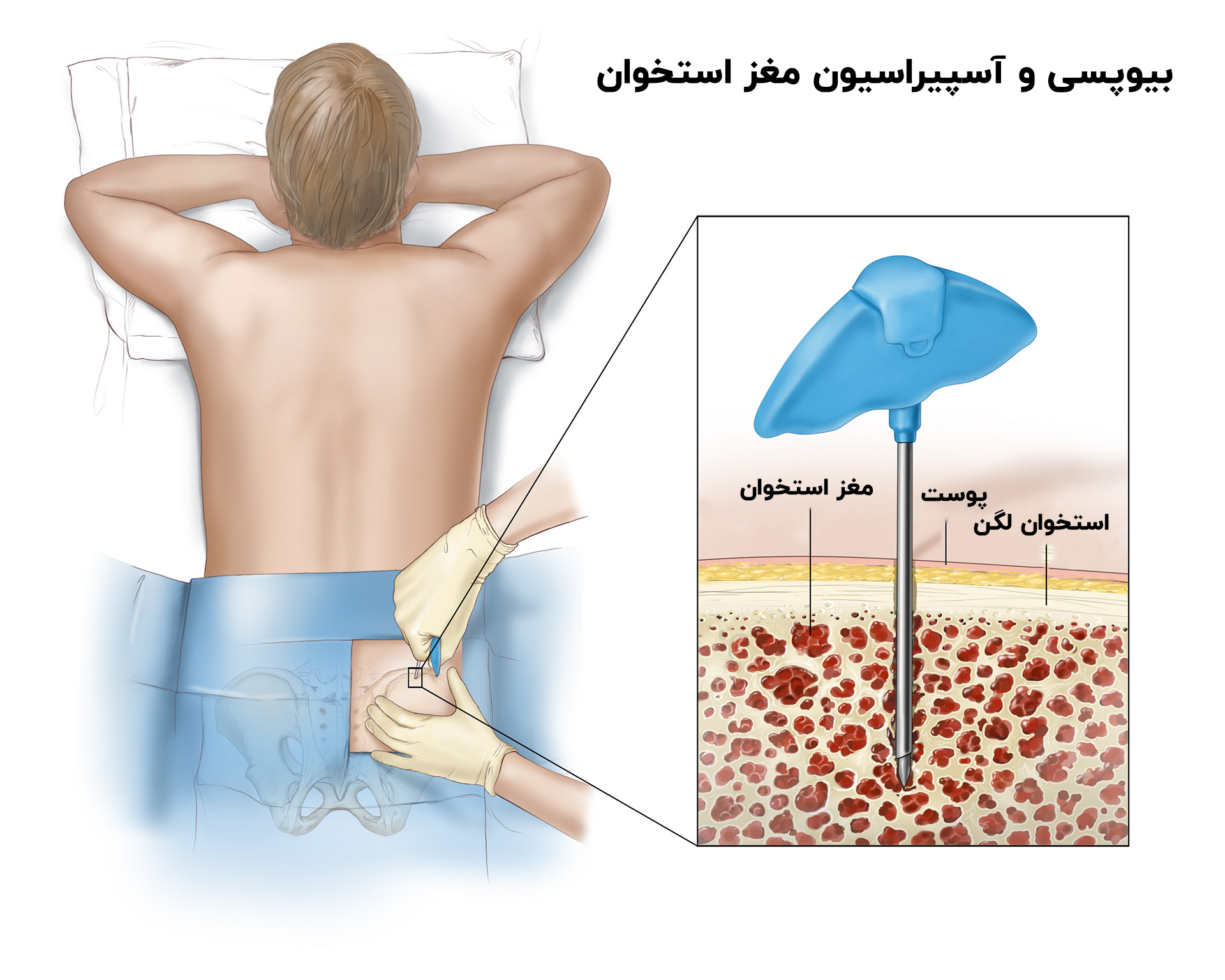 بیوپسی مغز استخوان