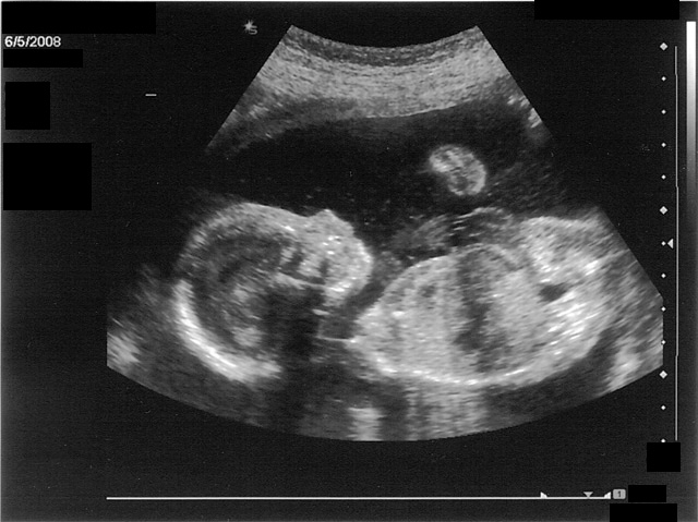 بچه در 6 ماهگی حاملگی