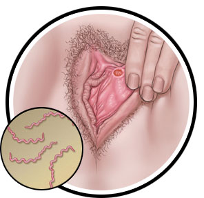 زخم سفلیس درون واژن
