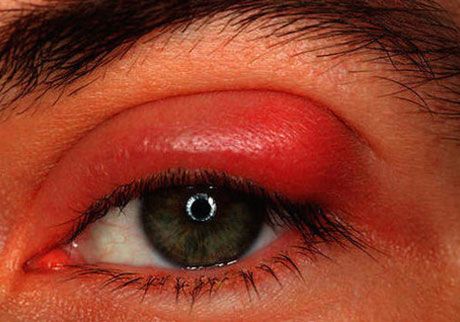 stye