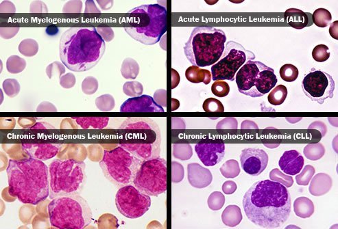 انواع سرطان خون با تحلیل سلول‌ها