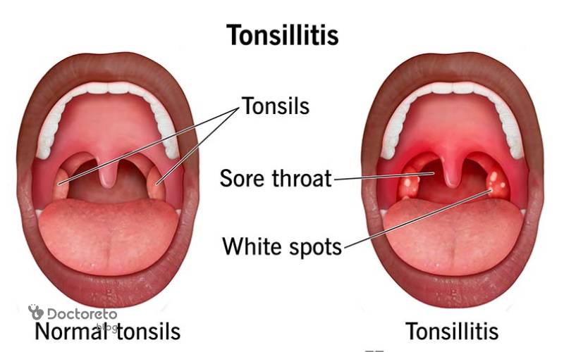 عکس لوزه سالم و ناسالم