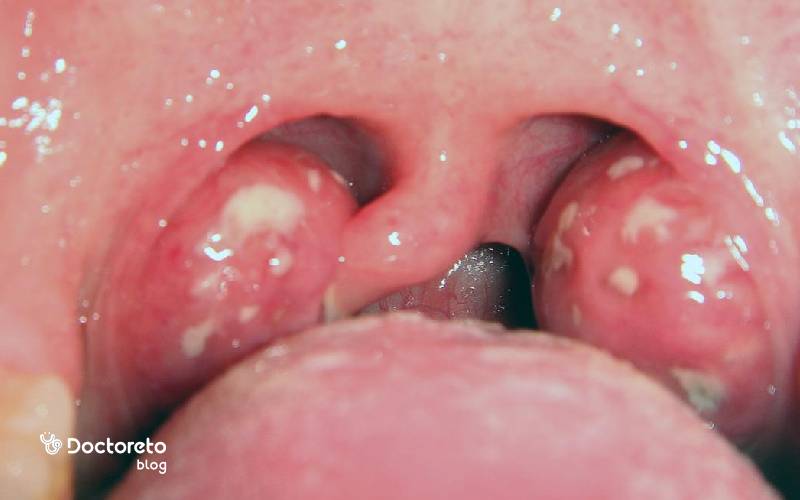 گوشت اضافه در لوزه