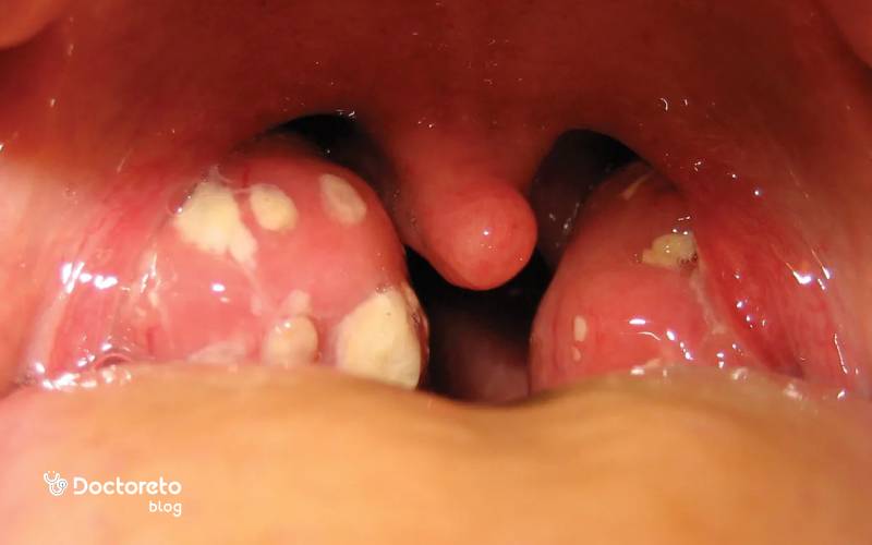 عکس لوزه گلو با دانه‌های سفید