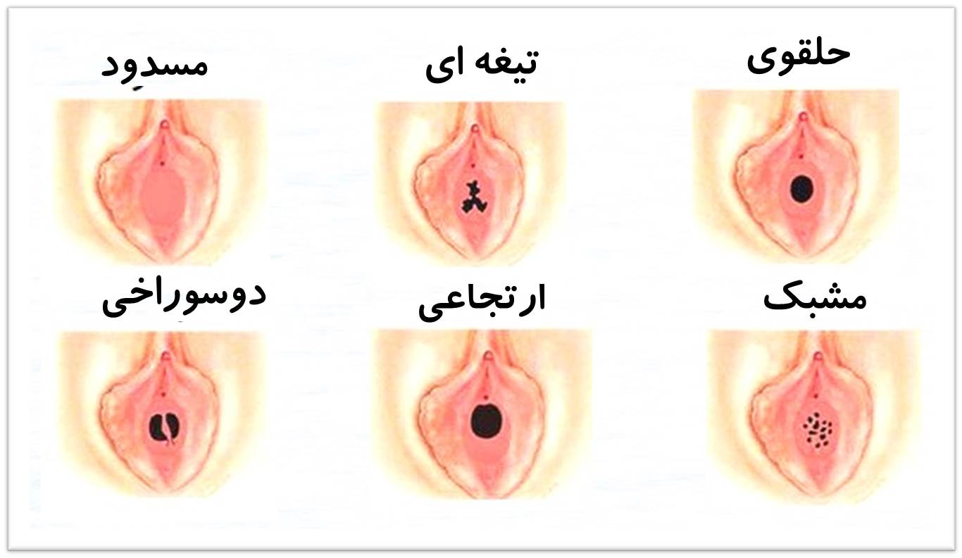انواع-پرده-بکارت
