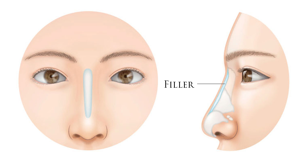 nose-filler
