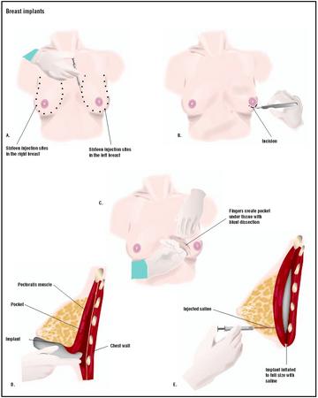 breast/augmentation/procedure