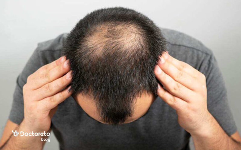 روش کاشت مو BHT (Body Hair Transplant)