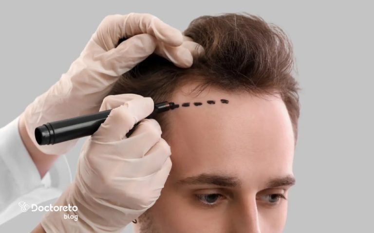 همه نکاتی که باید درباره کاشت مو بدانید