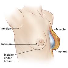 breast/augmentation/incision