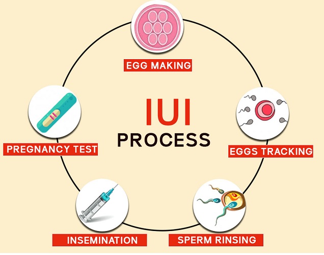 IUI-treatment