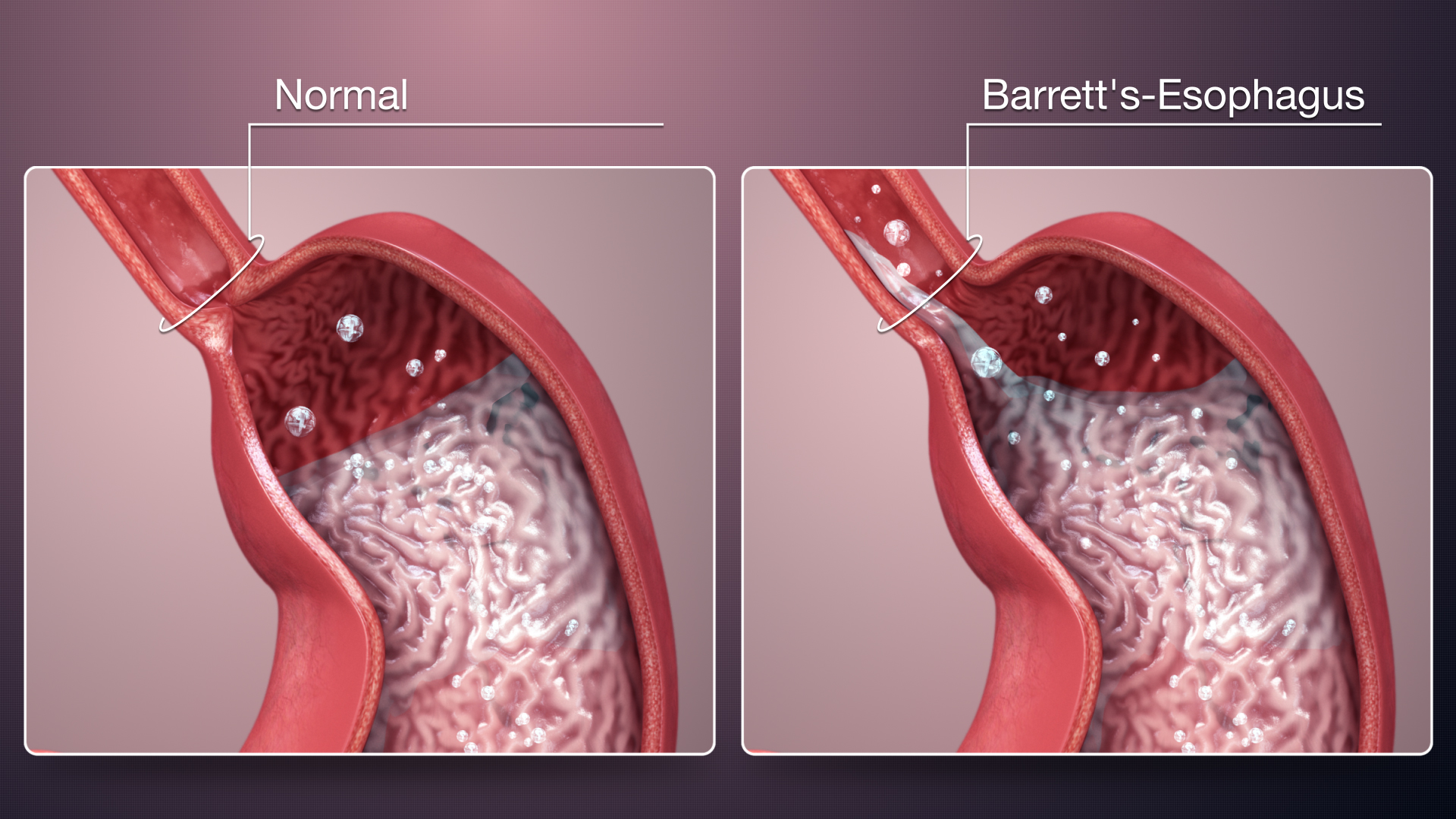 Barretts-Esophagus