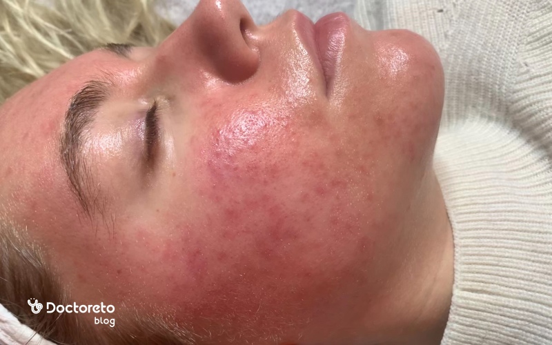 عکس صورت بعد از میکرونیدلینگ
