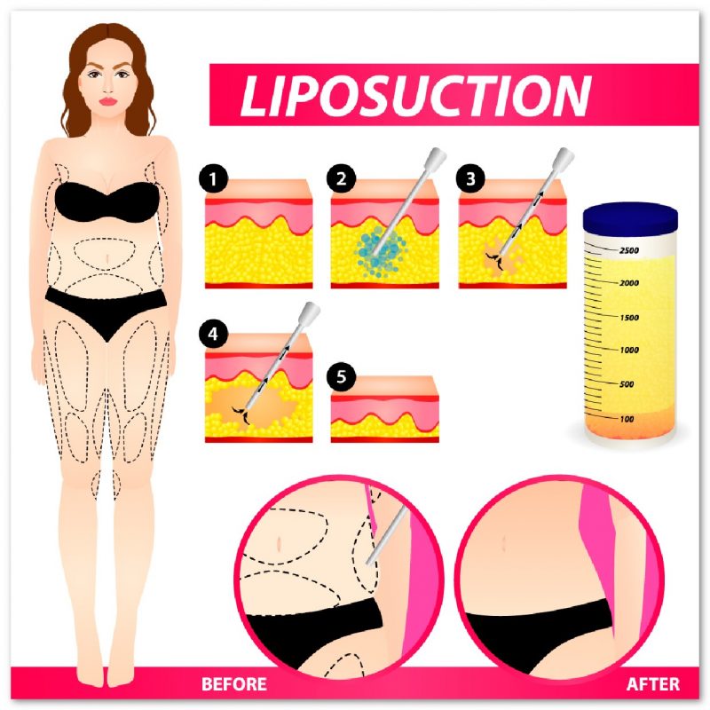Liposuction