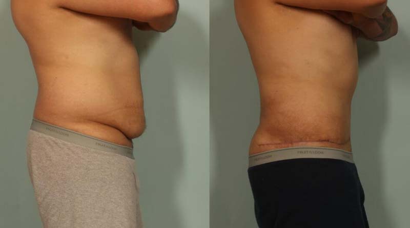 abdominoplasty