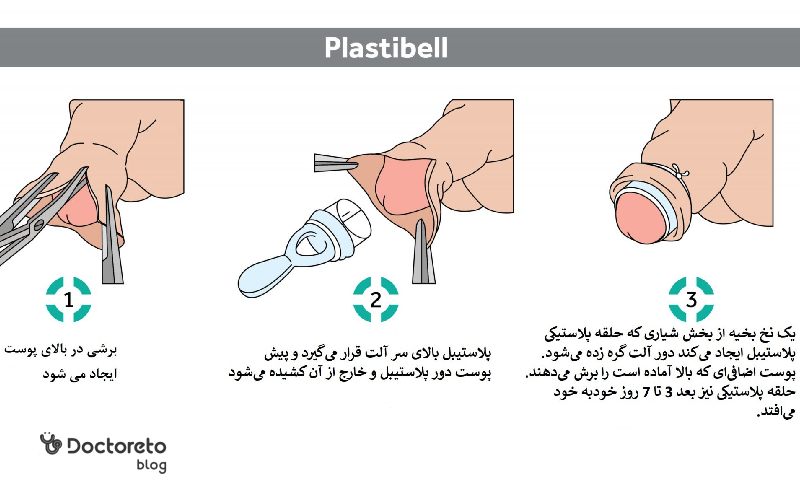 درد ختنه نوزاد چقدر طول میکشد؟