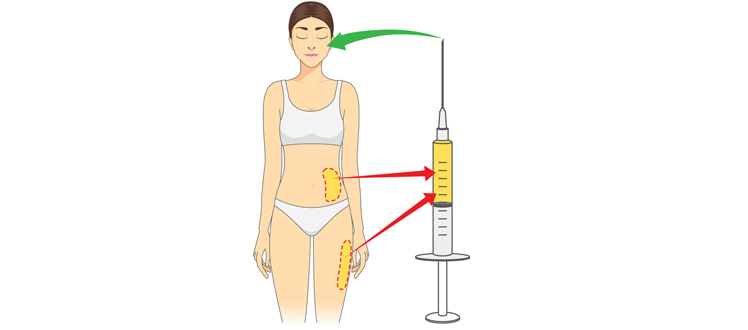 fat-injection
