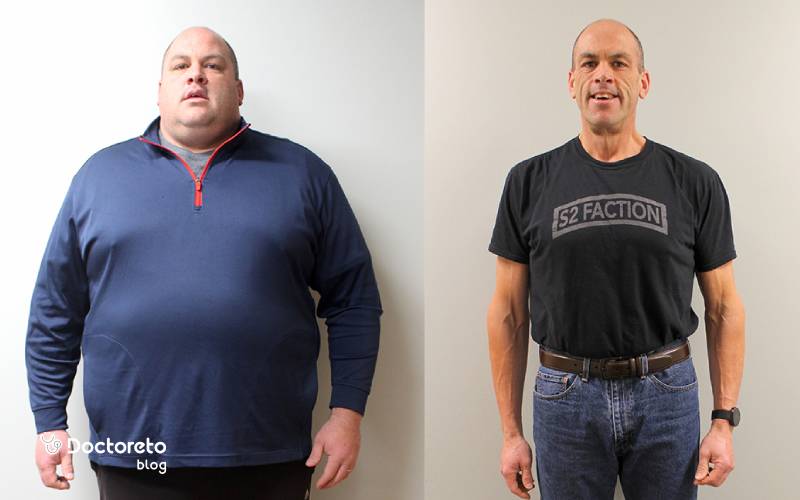 عمل اسلیو معده برای چه وزنی مناسب است؟