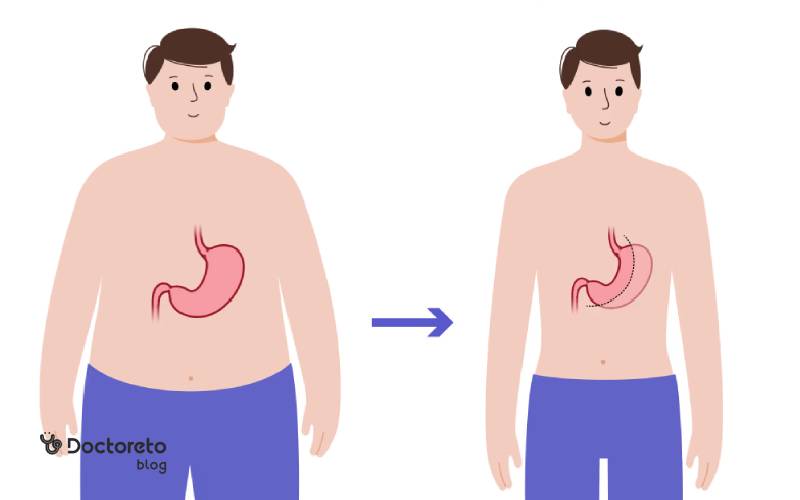 رژیم غذایی بعد عمل اسلیو معده
