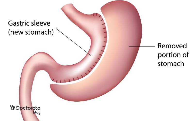 مکمل های بعد از عمل اسلیو