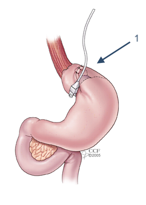 gastric-banding
