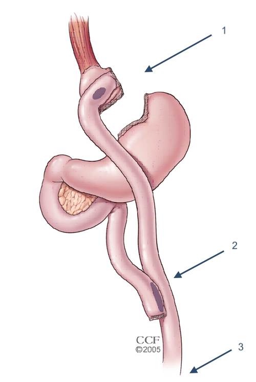 gastric-bypass
